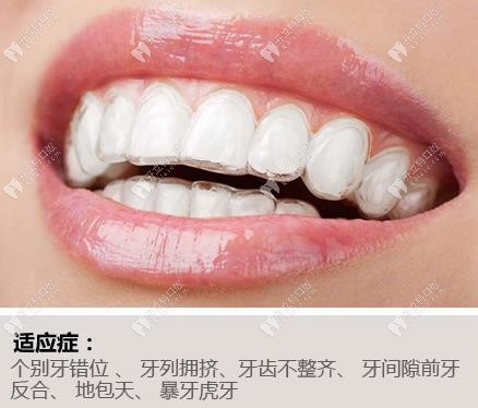 极光口腔的快速正畸将治齿,矫齿,美齿结合在一起,不用拔牙就可以排齐