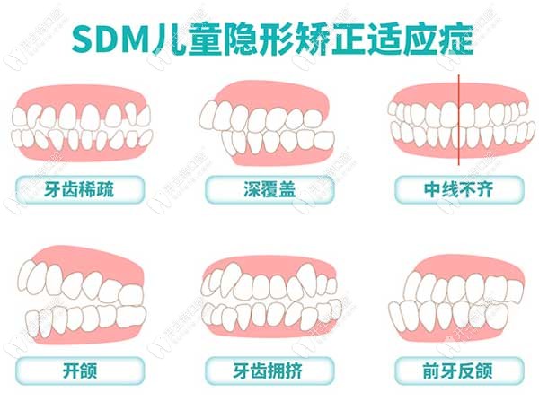 sdm儿童隐形矫正利用数字化系统可在替牙期完成早期干预