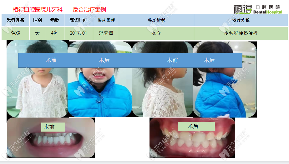 郑州植得口腔记录4岁儿童地包天通过活动矫治器成功改善反颌问题全过程