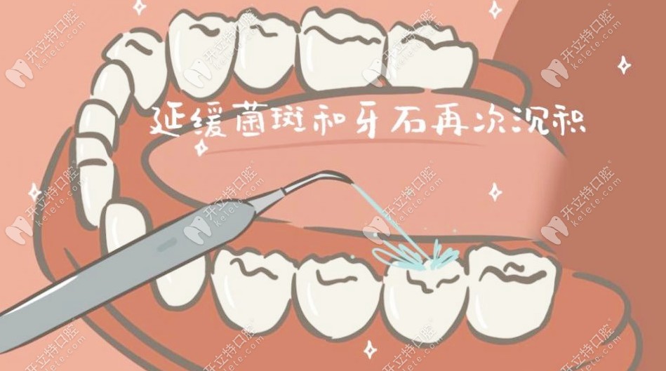 洗牙能够清楚牙菌斑