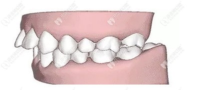 龅牙牙齿状况