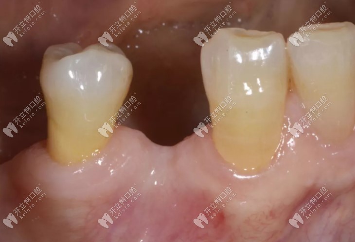 单颗牙缺失用iti亲水钛锆骨水平3.3mm种植体,1次手术微创种牙