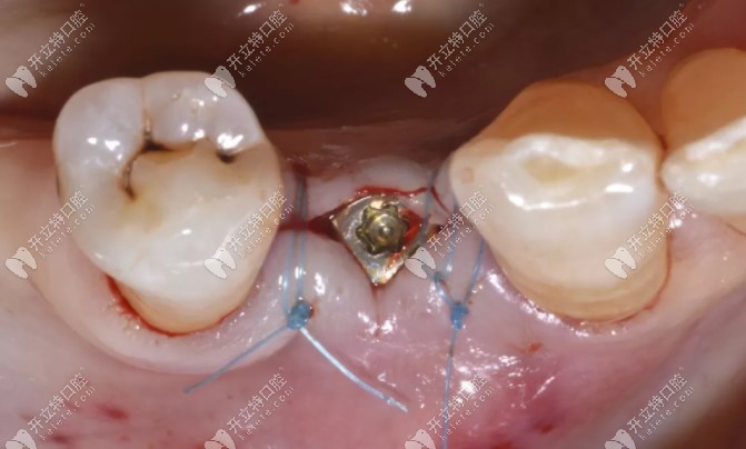 种牙手术后伤口缝合的照片