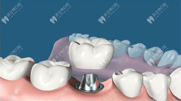 种牙第3步安装牙冠