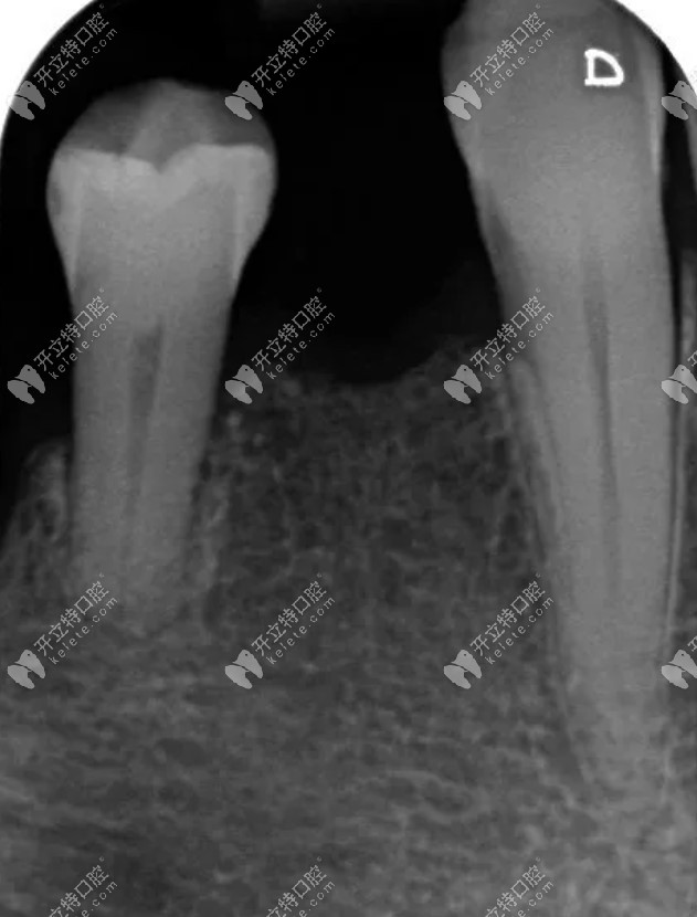  X 光片显示牙槽骨吸收情况