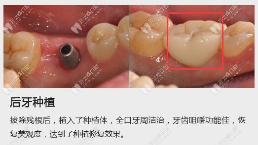 深圳同步齿科后牙区即刻种植效果
