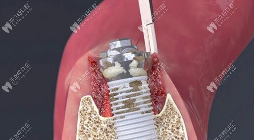 种植体周围炎的原因及治疗方法大解析