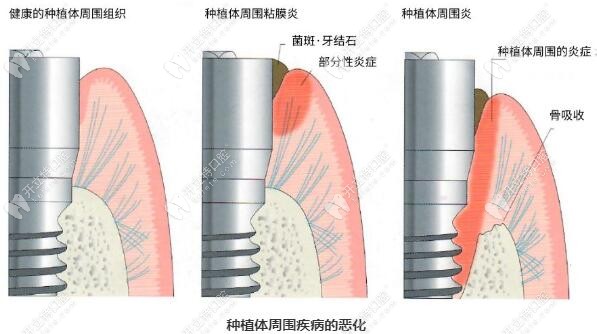 种植体周围疾病的恶化