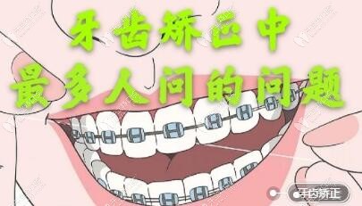 牙齿矫正常见问题：26岁后还能戴牙套吗