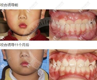 深圳青苗儿童口腔好不好,可从早期干预矫正的效果来评价