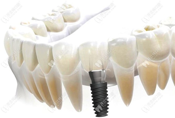 种植牙在牙槽骨中的模拟图