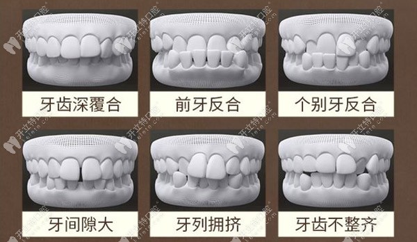 牙齿有着6种症状都可通过矫正改善