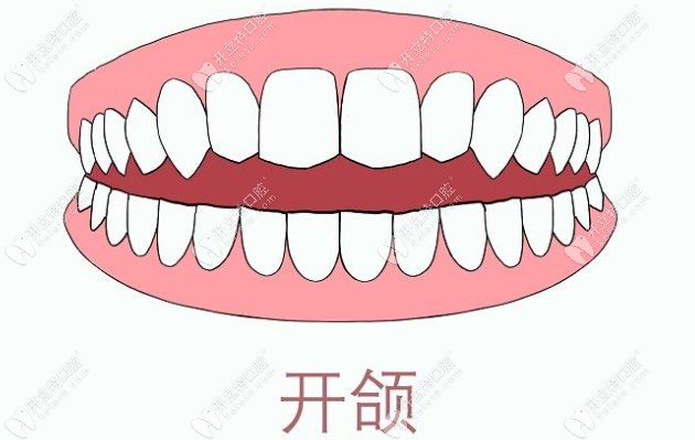 牙性开颌和骨性开颌区别