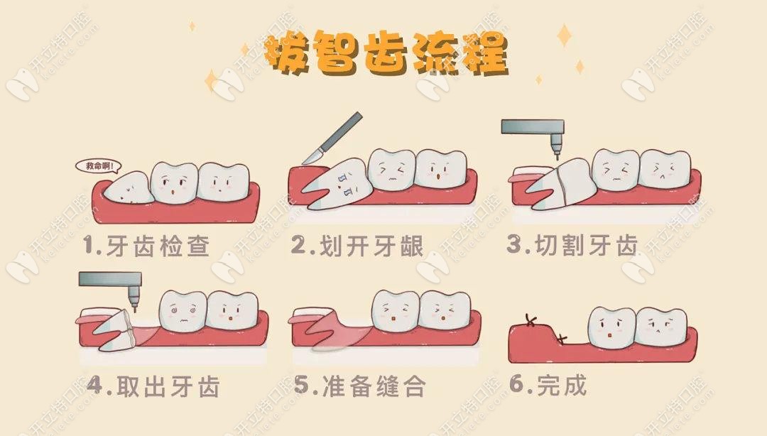 慈溪鼎植拔智齒的價格是多少錢？