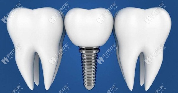 西尔口腔种植牙优势有哪些