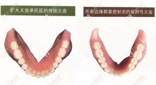 吸附性义齿基托与普通义齿基托区别