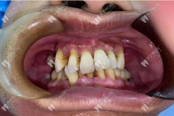真人测评南京雅度口腔严晓东的即刻半口种植牙技术杠杠滴