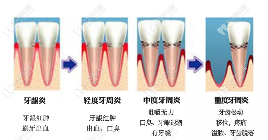 牙齿畸形会引起牙周炎，导致牙齿脱落