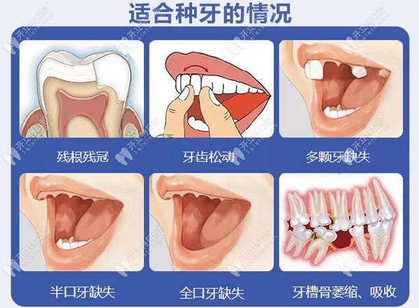 图中六种情况都适合种植牙