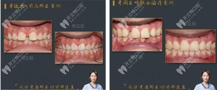 付丽群医生：牙缝大和牙周正畸病例图