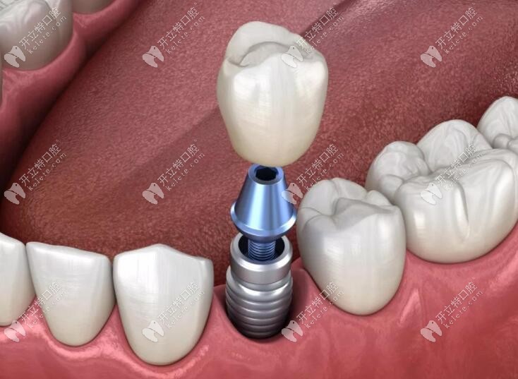 牙齿种植修复技术