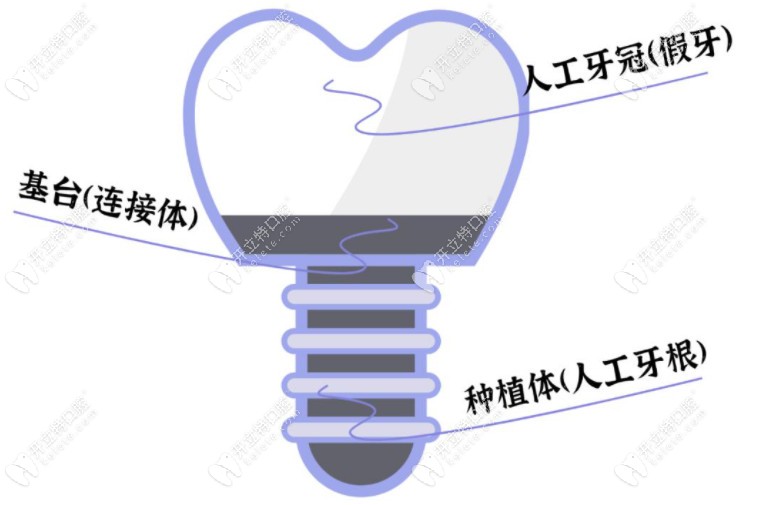 种植牙用的钛基底是什么