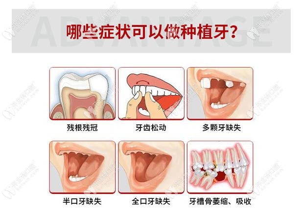 哪些症状可以做武汉瑞博口腔的种植牙？