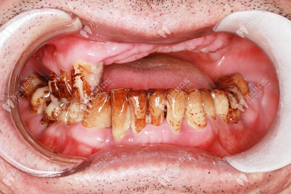 半口种植牙前的口内照