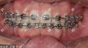 带金属牙套200天后：牙缝明显收紧