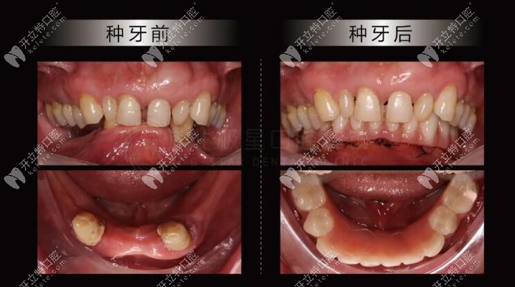 即刻负重种植牙的效果图