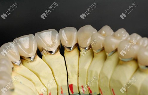 纯钛聚合瓷牙