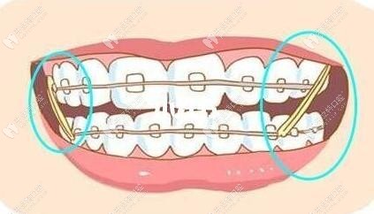 牙套挂皮筋作用图解图片