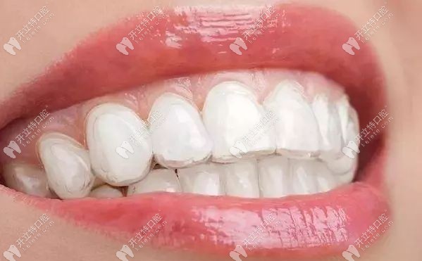 牙博士口腔隐形牙套正畸
