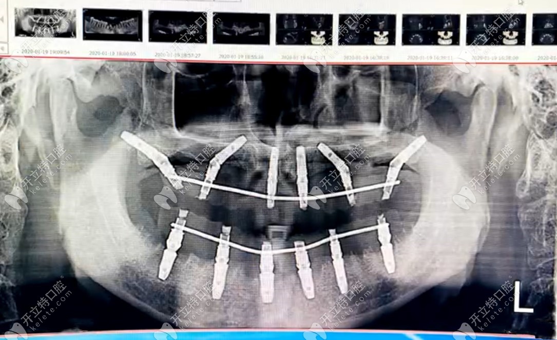 做完allon6全口种植牙拍的CT