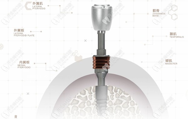 常州北极星口腔穿颧穿翼种植牙