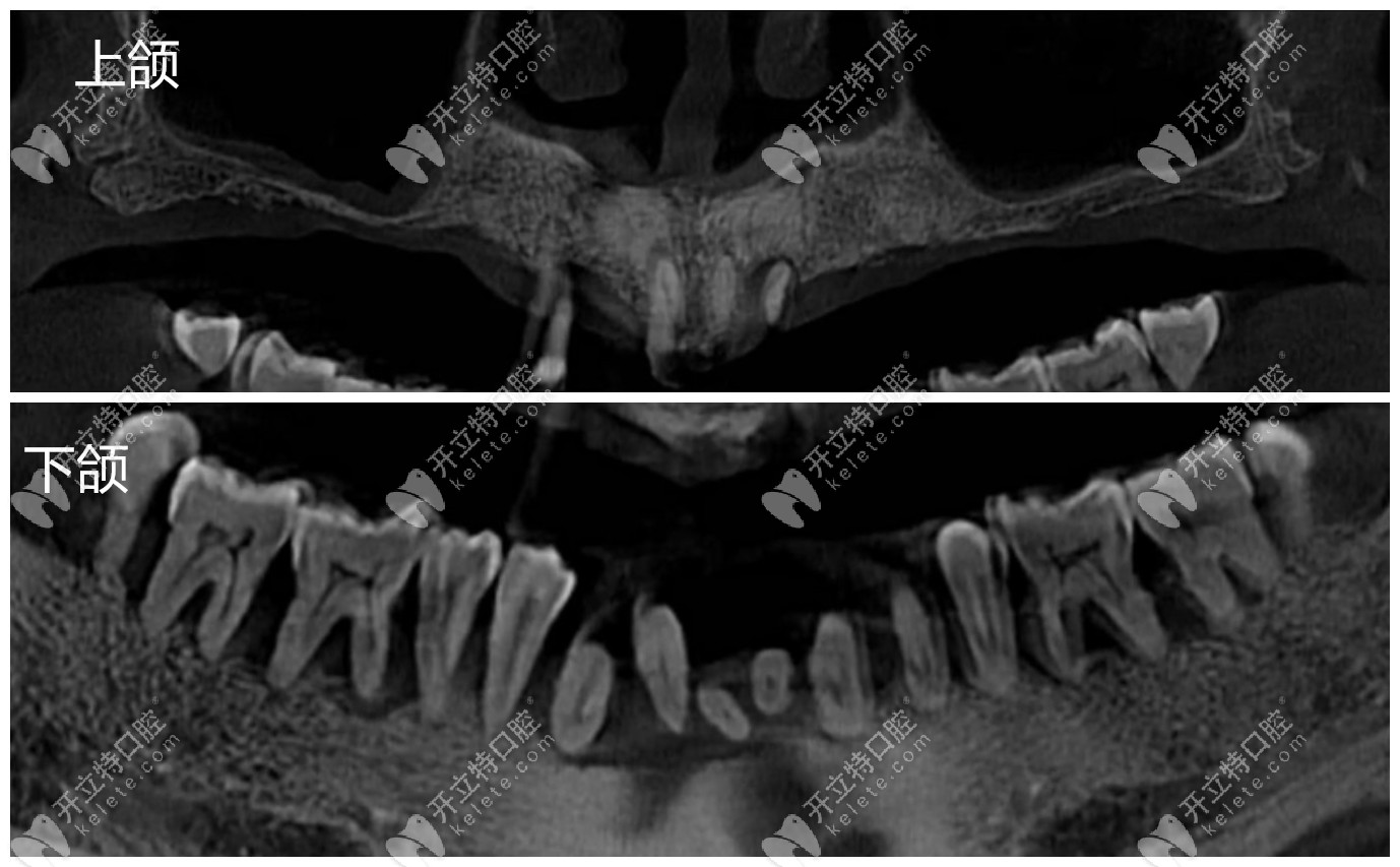 替牙期牙槽突裂患者行块状髂骨植骨术的初步疗效分析
