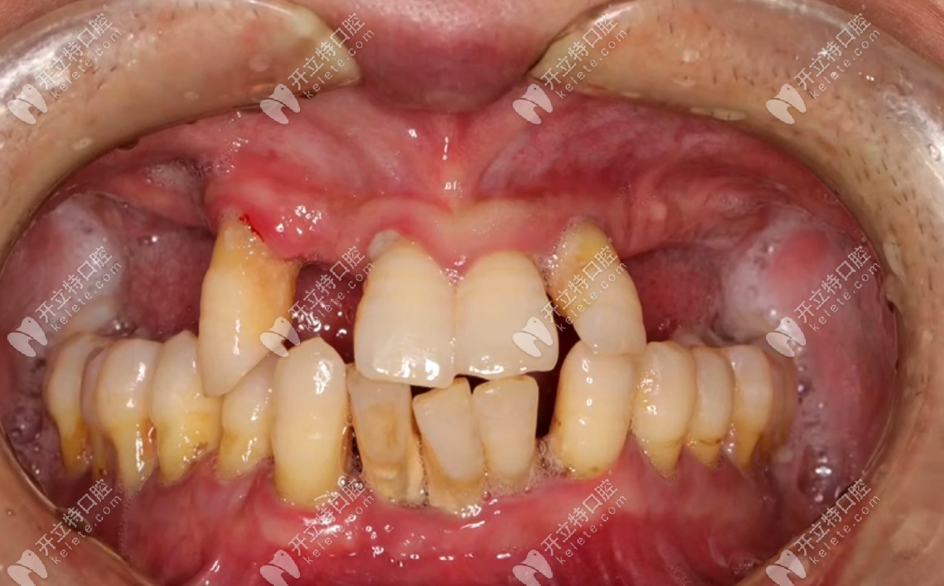 北京钛植口腔重度牙周炎在北京钛植的种牙经历,拔掉余牙做allon6全口种植