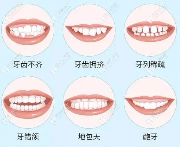 各种牙齿畸形图片