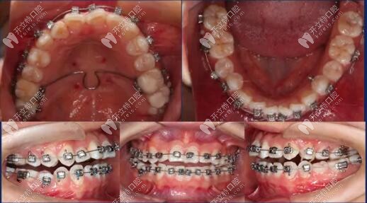 西安美奥口腔牙齿拥挤矫正病例