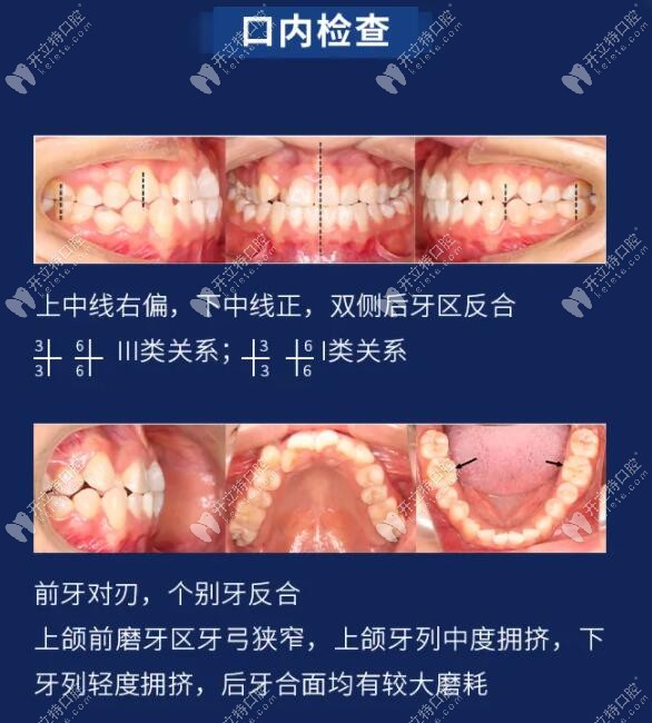 正畸前口内情况