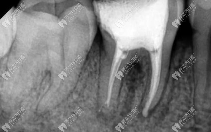 后牙根管治疗X线片