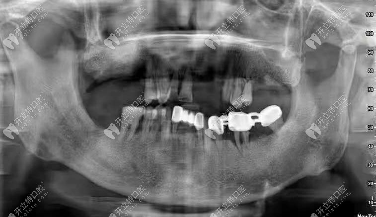 从拍的CT片中也可看到牙槽骨有一定吸收