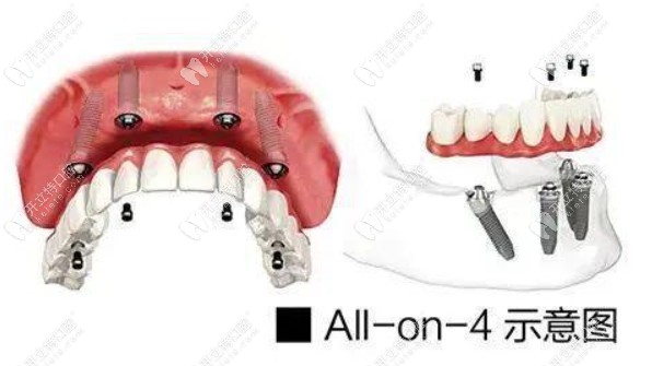 Allon4种植牙技术