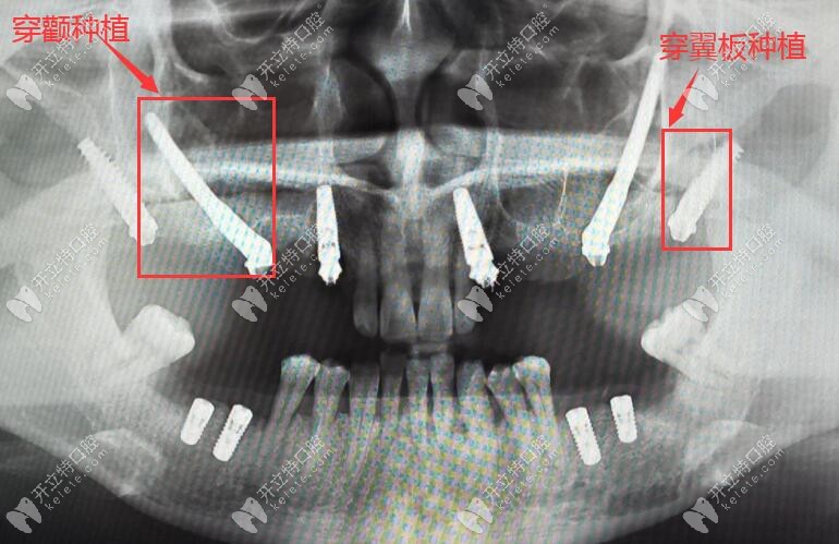 格伦菲尔口腔穿颧穿翼板种植牙CT片
