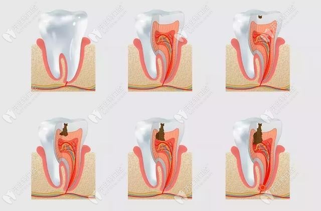儿童牙齿龋坏的发展过程