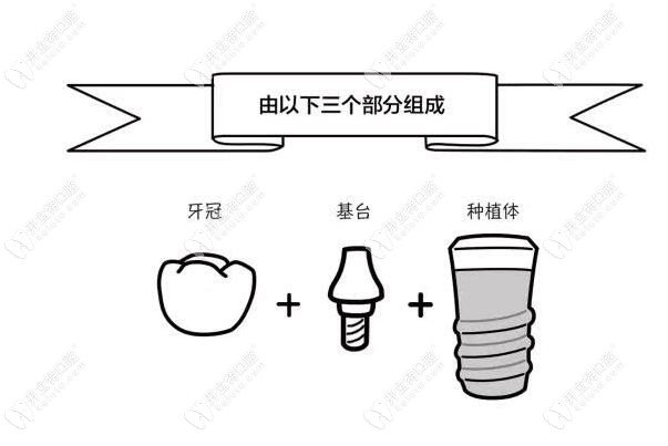 种植体组成