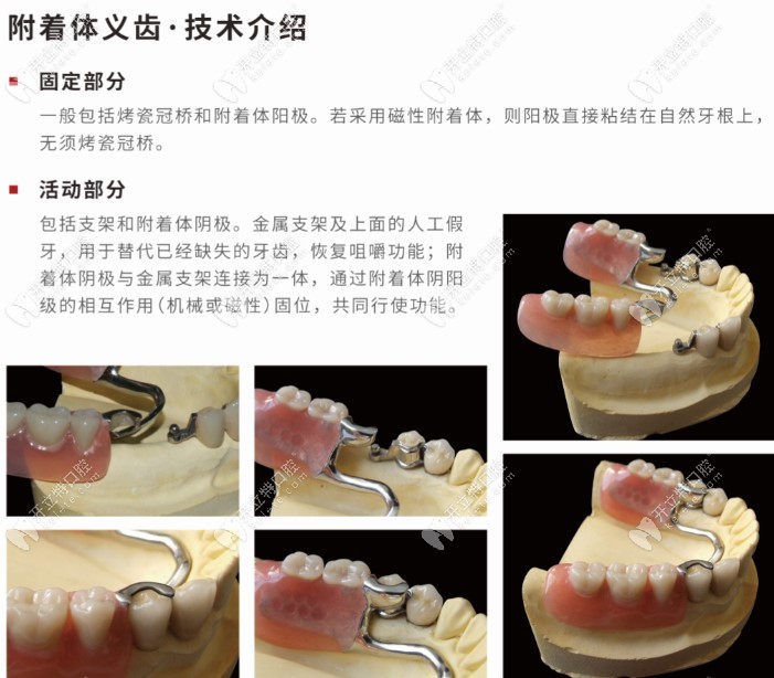 什么是精密附着体介绍