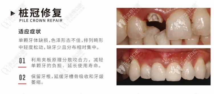 桩冠修复的优势点介绍