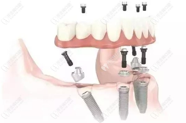 ALL- on-4种植牙技术