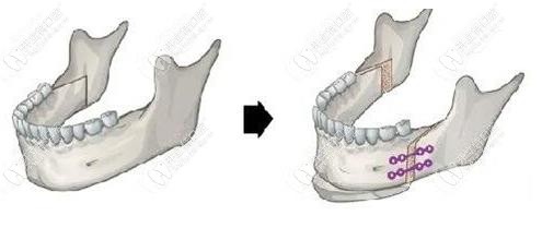 頦成型手術(shù)示意圖